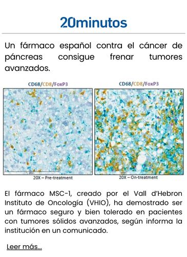 Un fármaco español contra el cáncer de páncreas consigue frenar tumores avanzados.