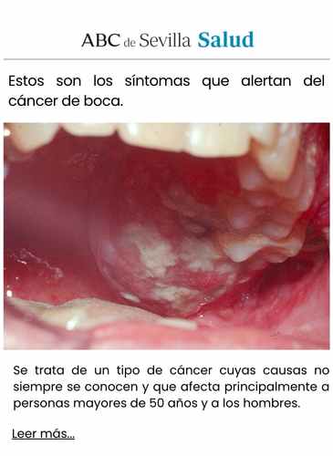 Estos son los síntomas que alertan del cáncer de boca.